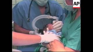 Operation Begins On Toddler With Fused Legs