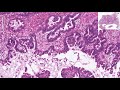 Serous Borderline Tumor/Atypical Proliferative Serous Tumor - Histopathology