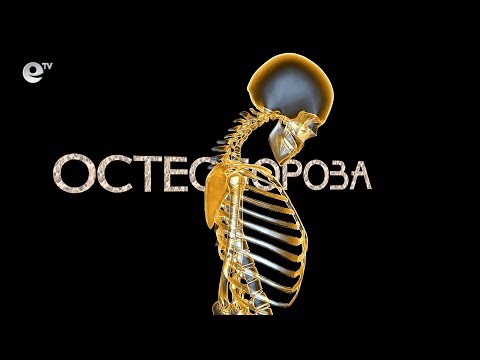 Здраве - Остеопорозата - тихият убиец