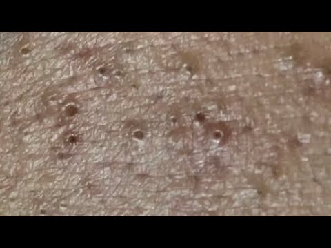 ￼Blackheads.