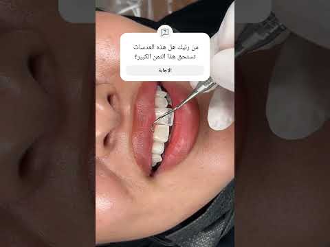 اغلى عدسات اسنان لاصقة في العالم