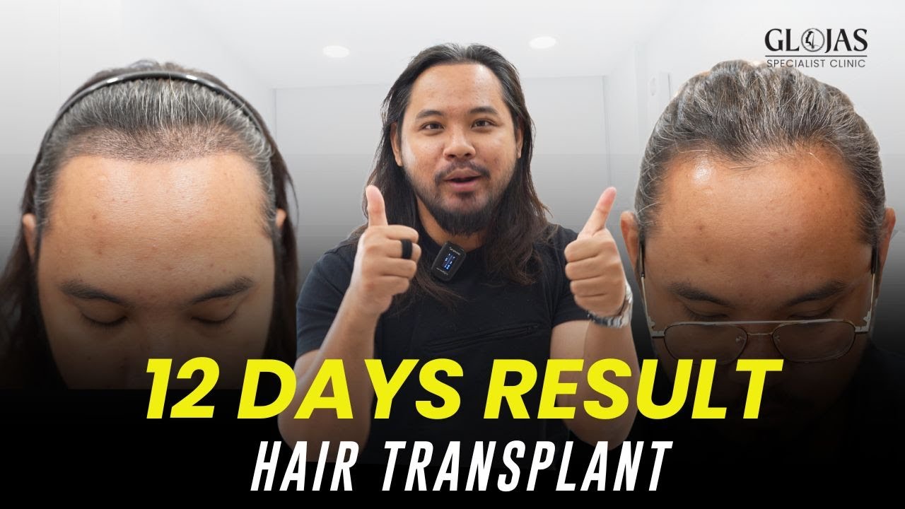 How Does Hair Transplant Work? Complete Step-by-Step Process 1 How Does Hair Transplant Work? Complete Step-by-Step Process in Malaysia