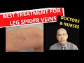 What are leg spider veins and how are they removed  causes and treatment by microsclerotherapy