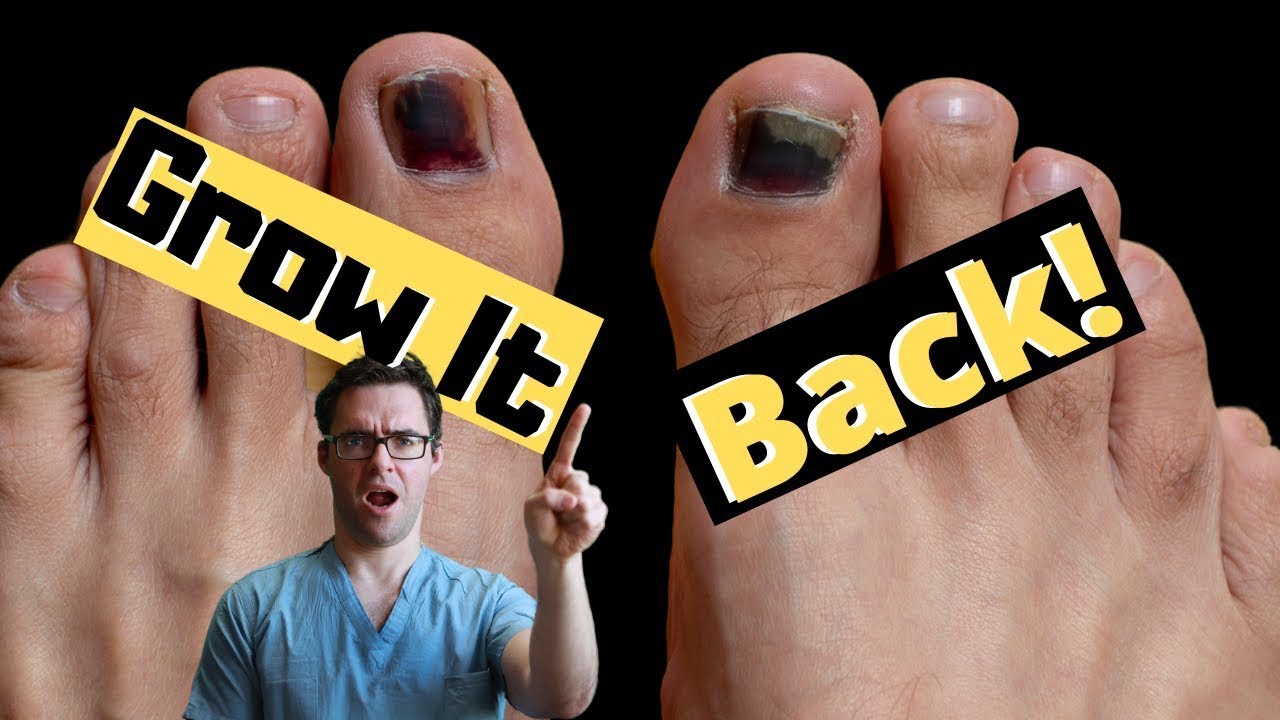 Black Toenail Falling Off: [Causes, Symptoms & Best Treatment!]