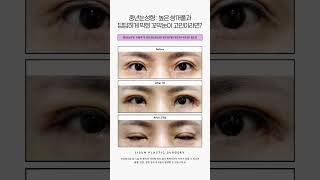 중년눈성형 : 높은 쌍꺼풀과 답답하게 막힌 꼬막눈이 고민이라면?(상안검, 풀트임) #시선성형외과 #shorts