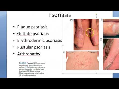 Medicine Psoriasis Histology Types Treatment Auspitz sign