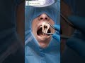 what happens when a tooth splits in half! #shorts