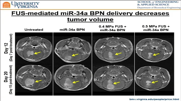 Curley - MRgFUS delivery of miRNA-34a gene vectors...