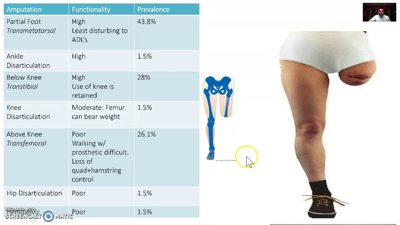 Lower Limb Amputation Levels