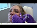 Dermal filler treatment demo restylane refyne  defyne  voluma  skin by lovely