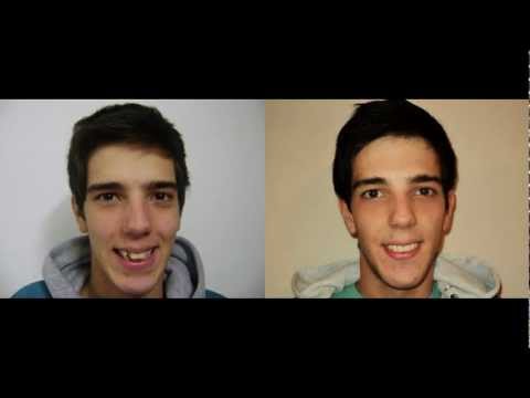Ortodoncia: antes/después