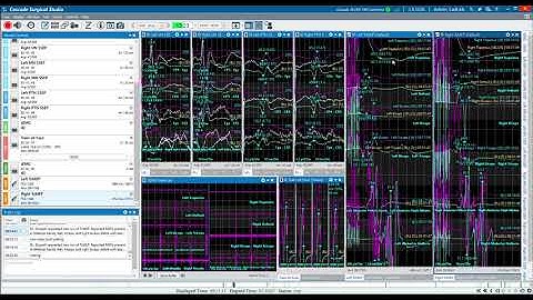 Intraoperative Neuromonitoring