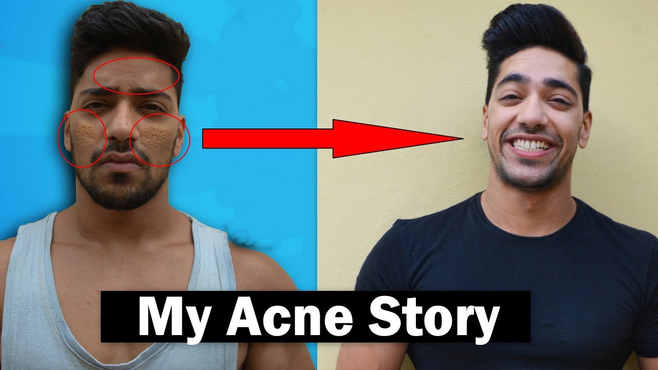 My Acne Story | How To Remove Acne | Remove Pimples For Clear Skin ...
