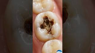 Fixing A Deep Cavity 🦷 3d Dental Animation | Composite Restoration #shorts #dentist