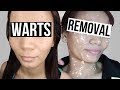 HOW TO REMOVE WARTS IN JUST 5 DAYS! | Flawless Warts Removal