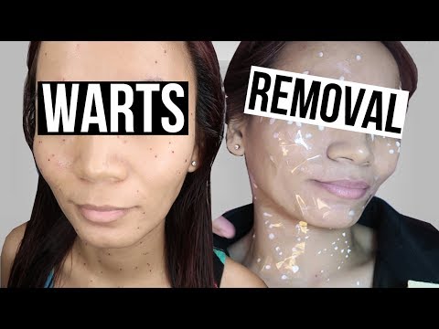 HOW TO REMOVE WARTS IN JUST 5 DAYS! | Flawless Warts Removal