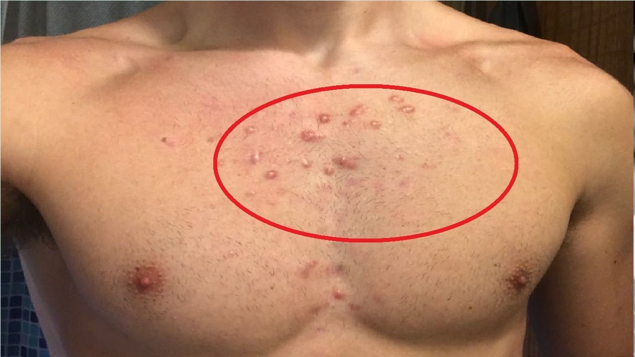 How To Get Rid Of Chest Acne Scars Fast Youtube