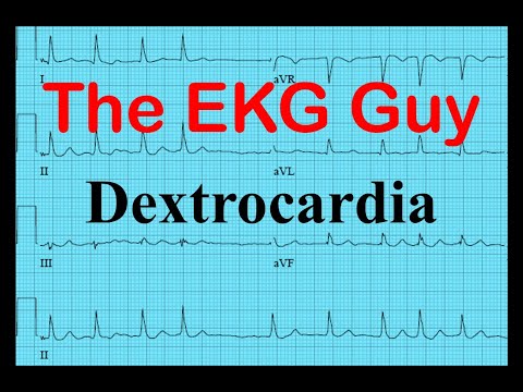 EKG/ECG - Dextrocardia | دی ای کے جی گائے - www.EKG.md