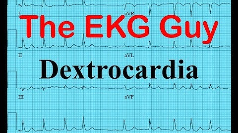EKG/ECG - Dextrocardia | The EKG Guy - www.EKG.md