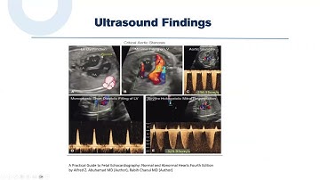 6.2. Hẹp van động mạch chủ - Đứt đoạn cung động mạch chủ (BS.CKII. Đỗ Thị Thúy Hằng)