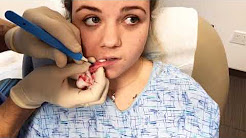 "ZITS AND BOILS AND CYSTS, OH MY!!!!" GROSS COMMON MEDICAL PROBLEMS GRAPHIC VIDEOS NOT FOR THE SQUEAMISH