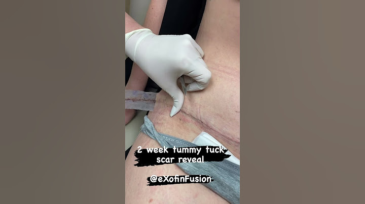 2 week tummy tuck scar reveal