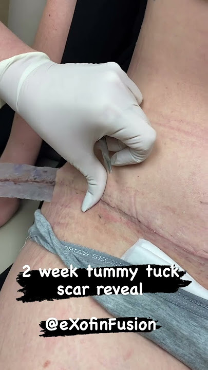 2 week tummy tuck scar reveal