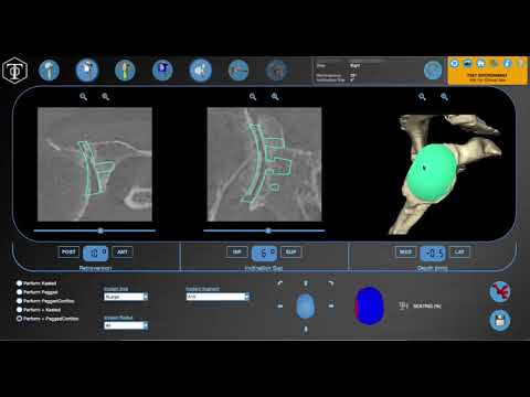 BLUEPRINT™ Case Planning with AEQUALIS™ PERFORM™+ featuring Dr. Eric Black