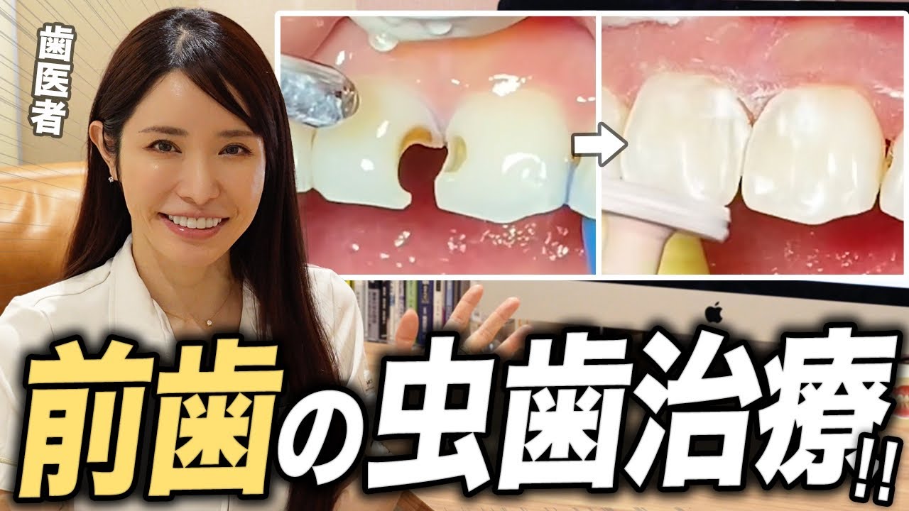 前歯の虫歯はどうしたらいい！？歯医者が徹底解説【歯科医 / コンポジットレジン / 詰め物】