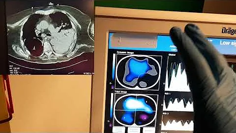 CASE STUDY// Electrical Impedance Tomography guided mechanical Ventilation
