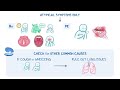 Gastroesophageal Reflux Disease