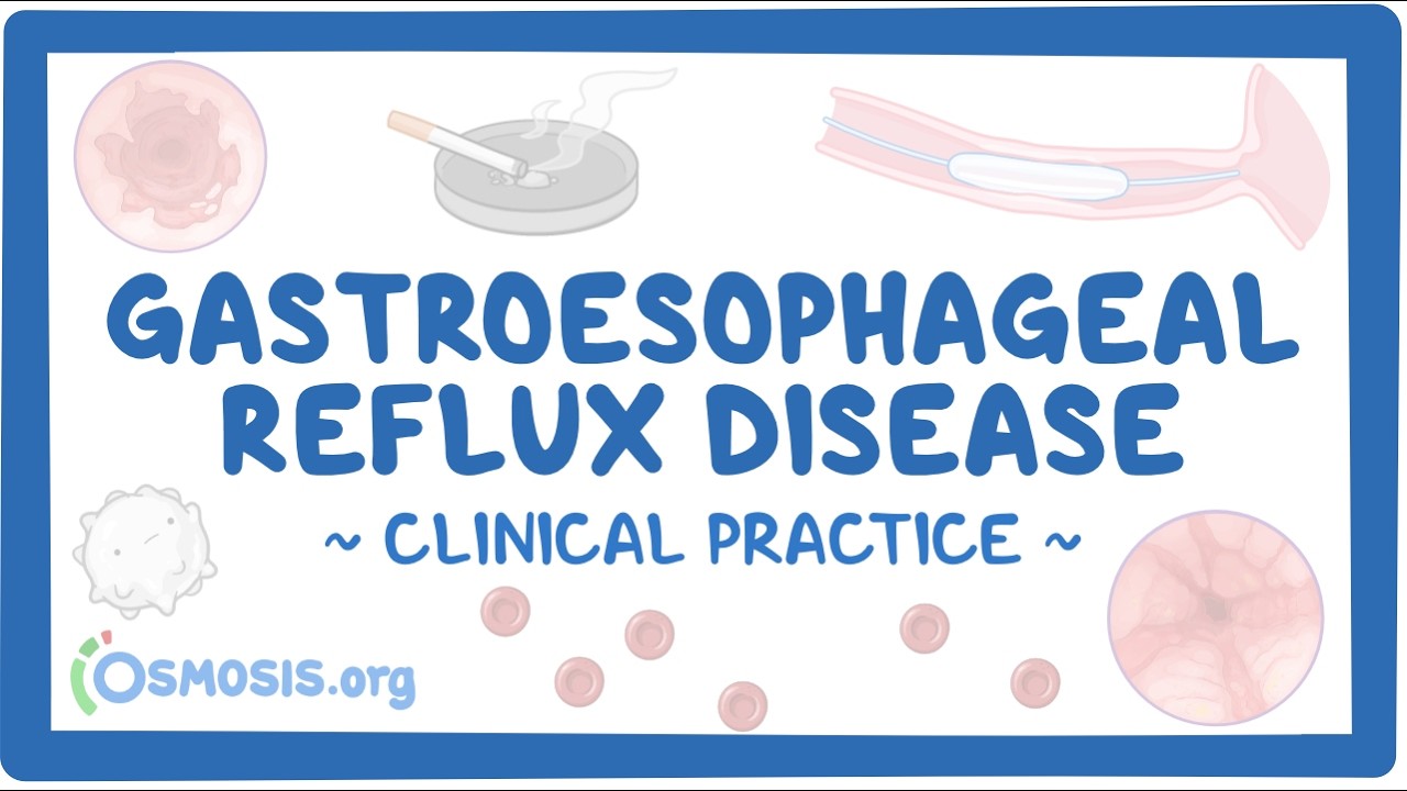 Gastroesophageal Reflux Disease — Transcript