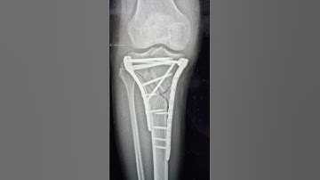 MIPO MEDIAL PLATE Proximal Tibia #ortho #trauma #surgeryeducation #anatomy