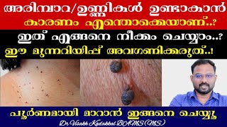 ശരീരത്തിൽ ഉണ്ടാകുന്ന ഉണ്ണികൾ (Skin Tag) പൂർണമായി മാറാനുള്ള എളുപ്പ വഴികൾ | Dr Visakh Kadakkal