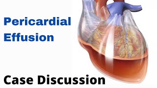 Case Discussion || Pericardial Effusion