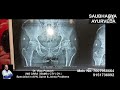 Xray changes before  after avn treatment by dr vijay  prakash 7007968664