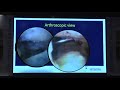 Rheumatoid arthritis in foot and ankle dr  rajesh simon olwa foot  ankle course