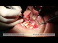 La chirurgie endodontique  dr matthieu marret
