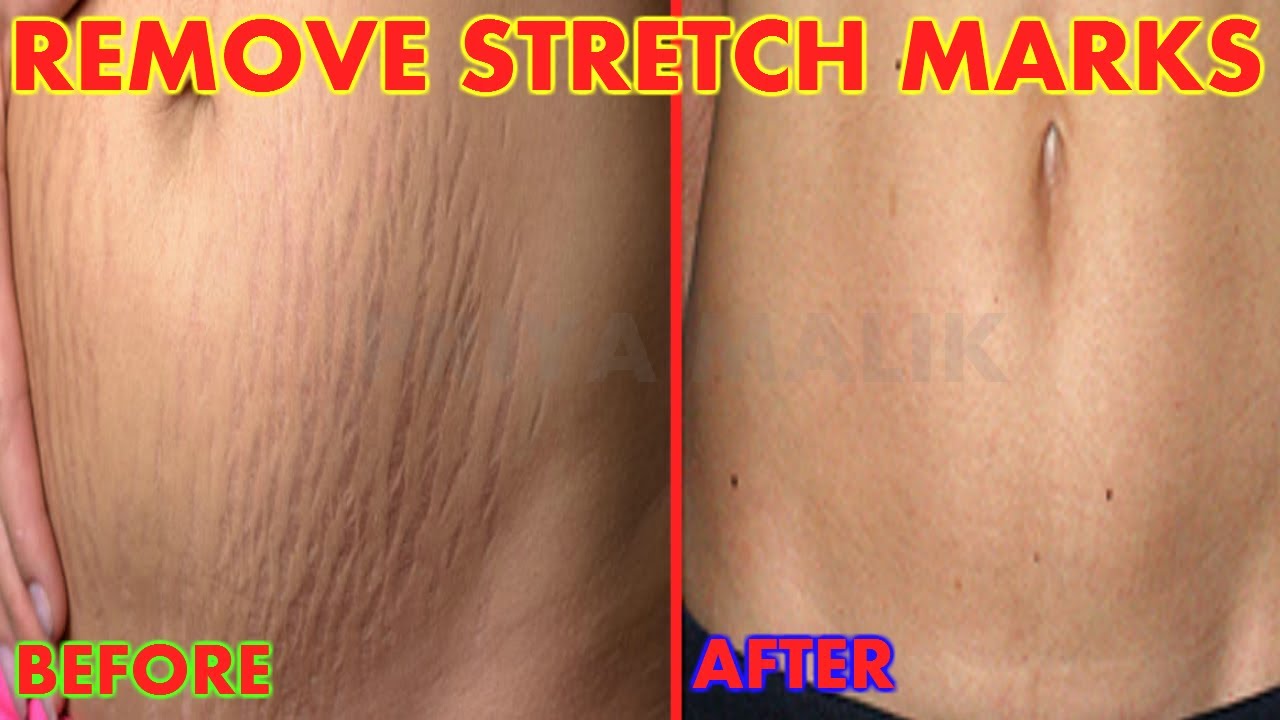 Image result for Try This Home Treatment To REMOVE Your Scars And Stretch Marks 100% Working !!1