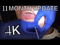 4k 11 month braces update putting my braces back on