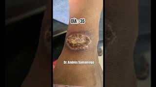 Úlcera Recuperación & Curación Leishmaniasis Dr. Andrés Samaniego