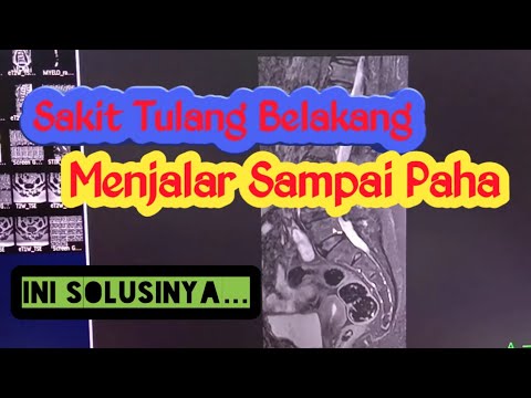 Cara Mendeteksi Skit Tulang Belakang