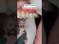 الحشوات الملغمي ة مضر ة لصح تكم لذا الأفضل إزالتها   