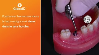 Comment extraire un faux-moignon sur implant In-Kone® plateforme ST ?