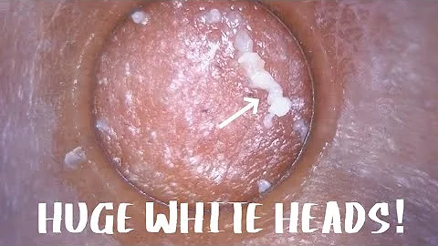 HUGE white heads on chin #acne #pimple