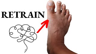 Get Rid Of Bunions For Good: Nervous System Retraining