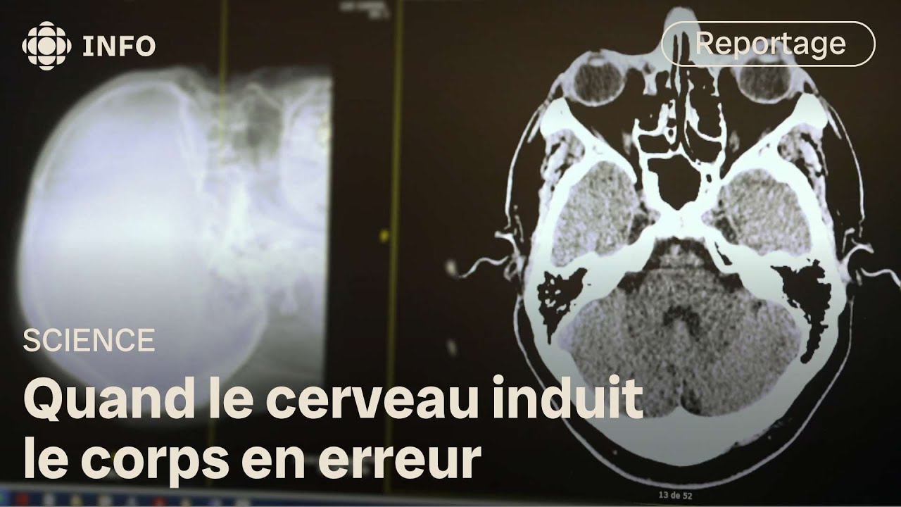 Trouble neurologique fonctionnel quand le cerveau déraille Découverte YouTube