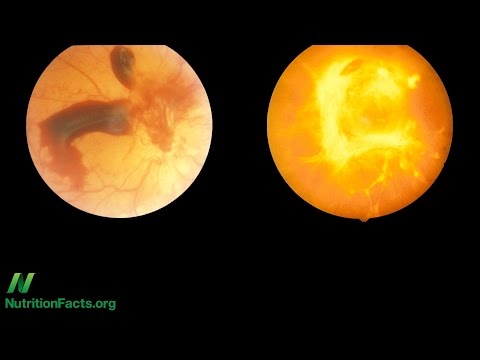 וִידֵאוֹ: האם photocoagulation panretinal מרפא רטינופתיה סוכרתית?