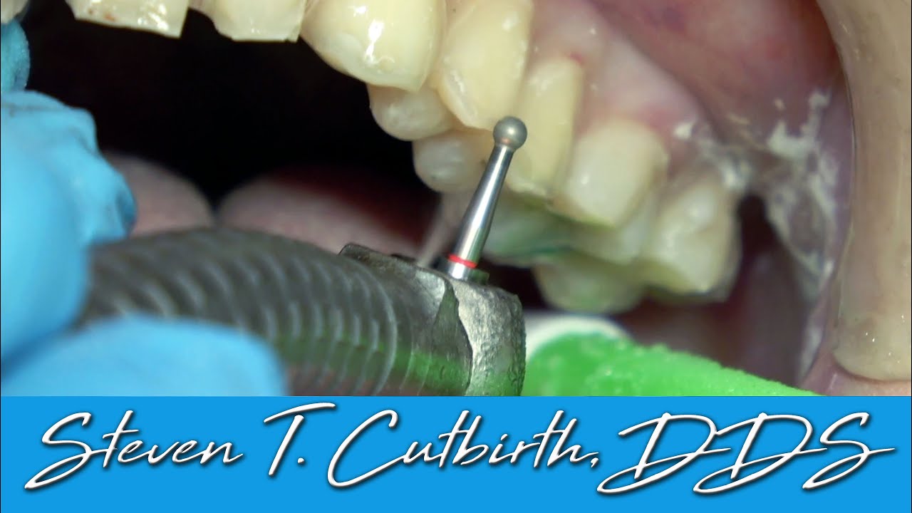How to Ensure Posterior Veneers Seat Ideally (Lug Cuts) Dental Minute with Steven T. Cutbirth