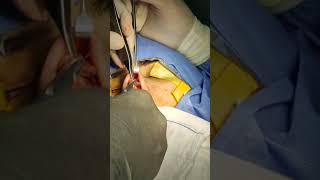 عملية تجميل الانف لايف كاملة/ تجميل الانف/ تنحيف الانف / Rhinoplasty operation